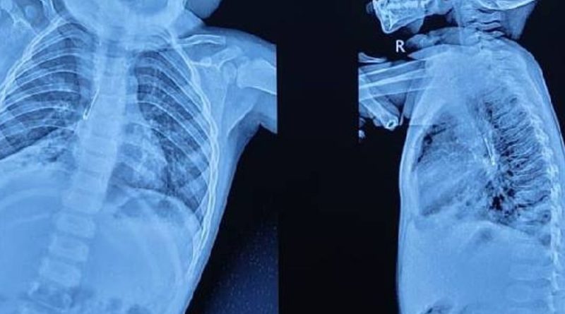 છોકરીના ફેફસામાં LED લાઈટ ફસાઈ:ખાંસી વધી જતાં દોઢ વર્ષના માસૂમ બાળકનો એક્સ-રે કરાવ્યો, જબલપુર મેડિકલમાં સફળ ઓપરેશન