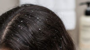 માત્ર મોંઘા શેમ્પૂથી નહીં જાય ડેન્ડ્રફ! અપનાવો 4 ઘરગથ્થુ ઉપાય, વાળની સમસ્યા થશે દૂર