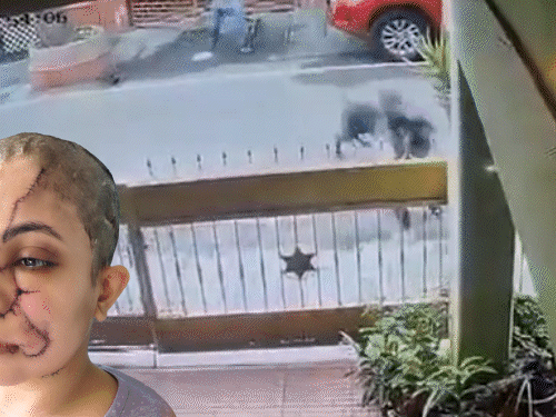 બેંગ્લુરૂમાં ખૂંખાર કૂતરાએ મહિલાનો ચહેરો ચીરી નાખ્યો:50 ટાંકા લેવા પડ્યા; બચાવવા પડેલા યુવકને હાથ પકડીને ઢસડ્યો, માલિકના હાથમાંથી ચેઈન છોડાવીને ભૂરાયો થયો