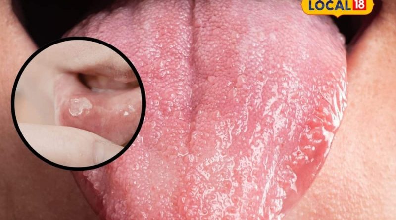 Oral Cancer: મોંઢાની નાની ચાંદી પણ બની શકે છે કેન્સરનો સંકેત! ડો. ચિરાગનો ચિંતાજનક ખુલાસો