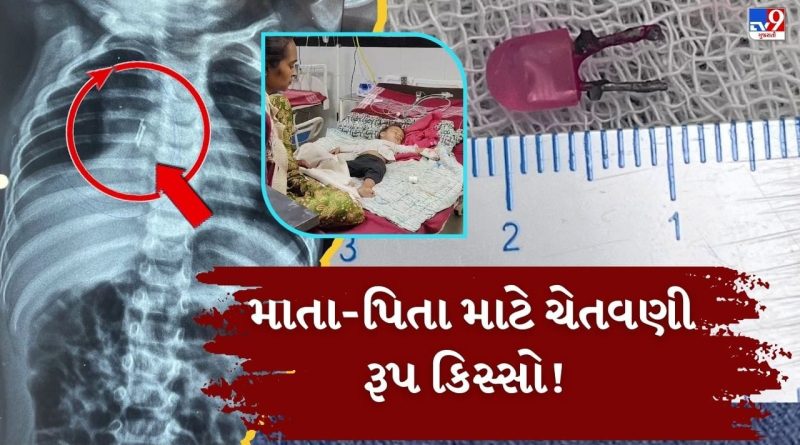 Breaking News : માતા-પિતા સાવધાન ! એક વર્ષના બાળકની શ્વાસનળીમાં ફસાયો LED બલ્બ, તબીબોએ VIDEO બ્રોન્કોસ્કોપી કરી બહાર કાઢ્યો