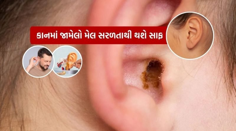 Earwax Remove : કાનમાં જામેલો મેલ કેવી રીતે કાઢવો? માત્ર થોડી જ વારમાં સરળતાથી કાન સાફ કરો, જાણો રીત