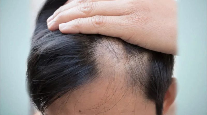 પુરુષોમાં નાની ઉંમરે ટાલિયાપણું કેમ ? ડૉક્ટરે કોને ગણાવ્યા જવાબદાર, જાણો બચવાના રામબાણ ઉપાયો