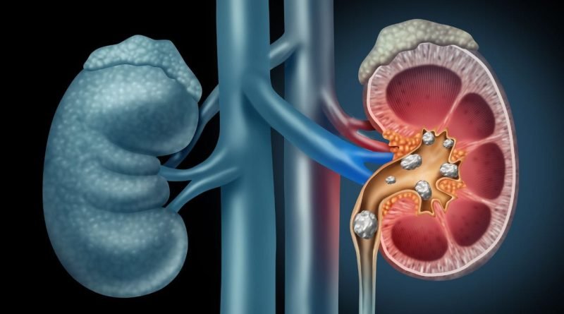 Health News : શું તમને કિડનીમાં પથરી છે અને યુરિનમાં લોહી દેખાય છે? જાણો શું છે કારણ