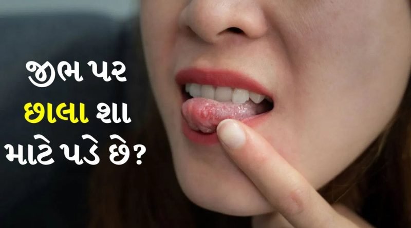 જીભ પર છાલા થવાનું કારણ શું છે? શું તે ખતરનાક રોગ છે, જાણો એક્સપર્ટ શું કહે છે